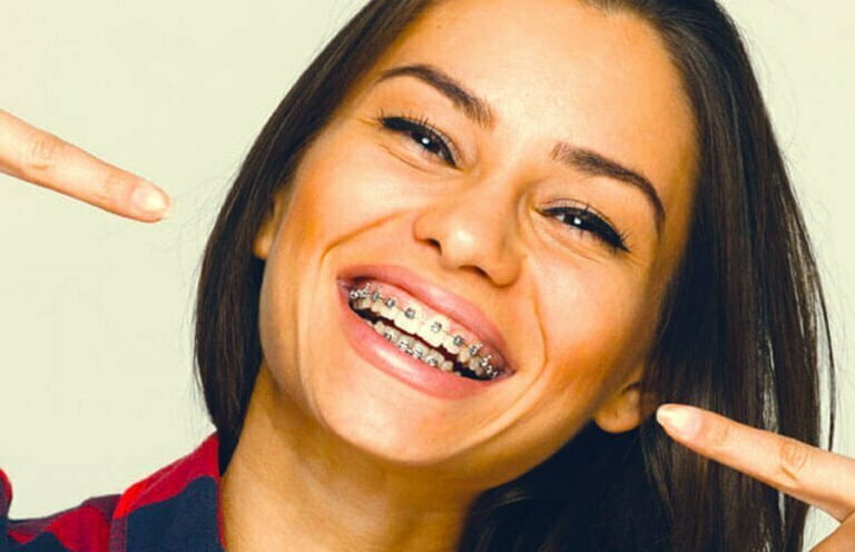 How to Kiss with Braces On? FAQs