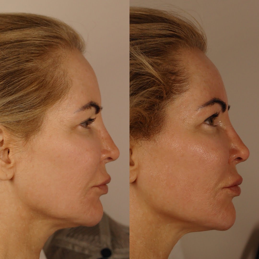 How to Lift Sagging Jowls with Microcurrent Therapy Slash and Scroll
