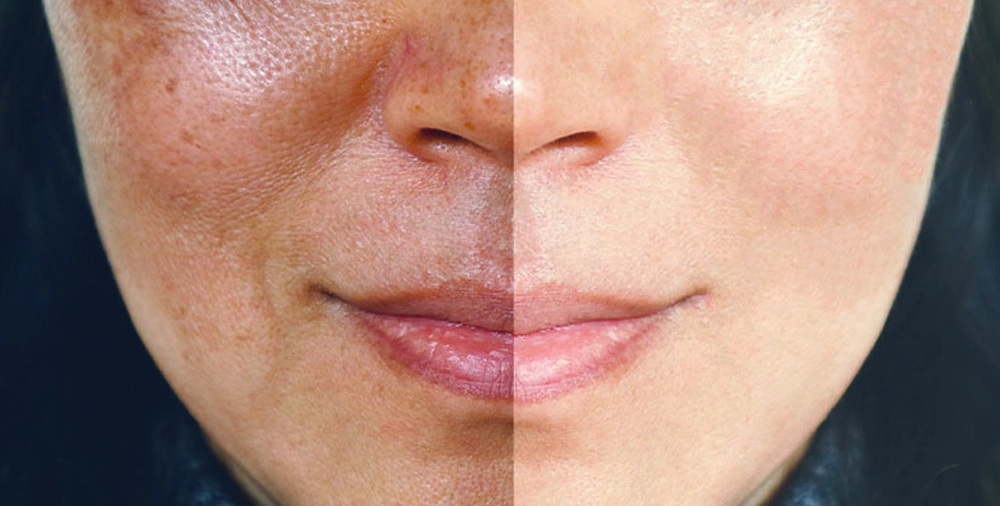 Led Light Therapy For Hyperpigmentation Shelly Lighting