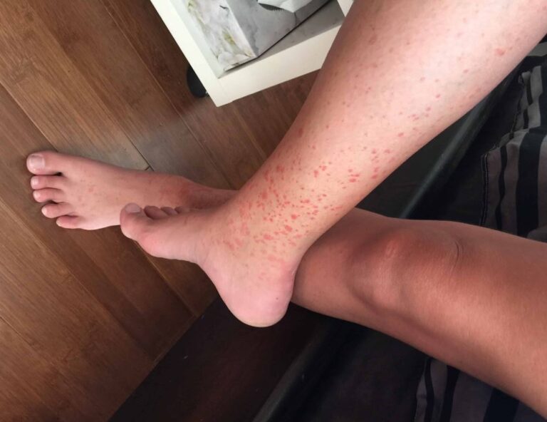 Bed Bug Bites vs. Mosquito Bites: How to Tell the Difference