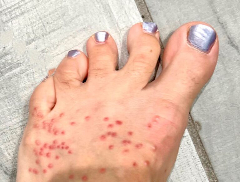 Does Epsom Salt Help with Chigger Bites? A Complete Guide