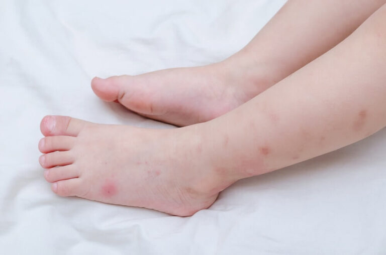 What Bug Bit Me The Ultimate Guide to Identifying & Treating Bug Bites