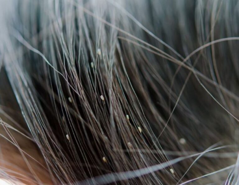 Can Bed Bugs Live in Your Hair? A Pest Expert’s Guide